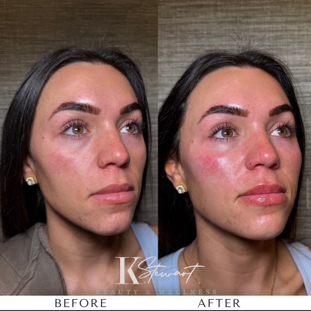 Facial balancing before and after, naturally balanced and harmonious features