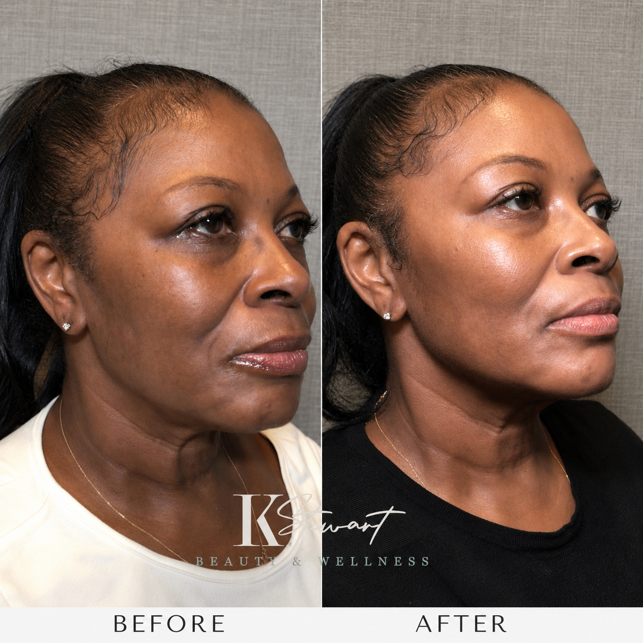 Facial contour before and after result