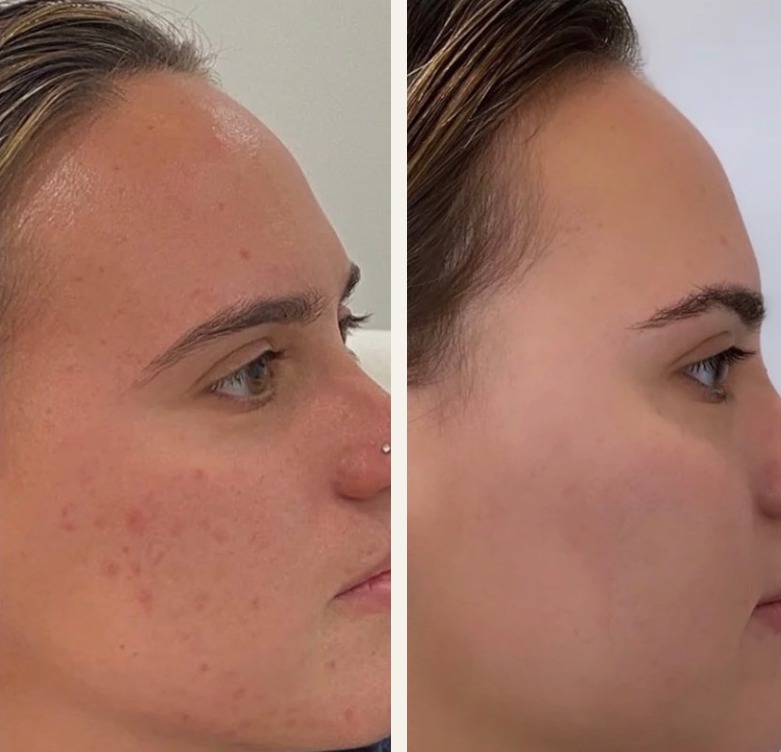 Skin clarity and texture before and after three treatments