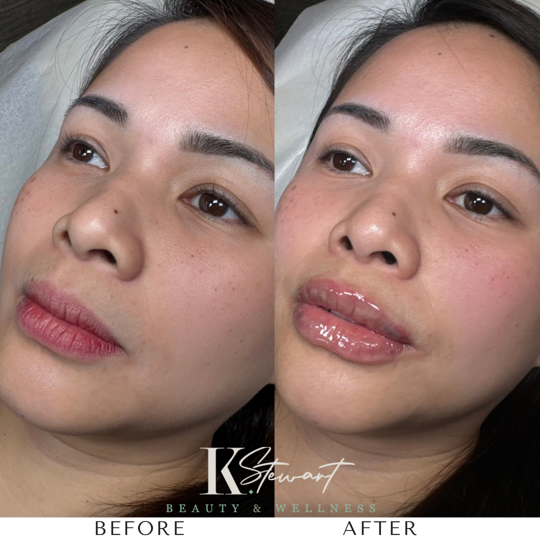 Lip filler before and after result