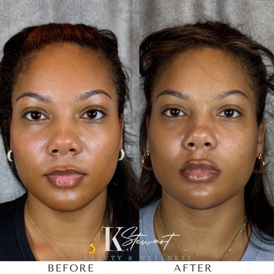 Facial rejuvenation before and after result