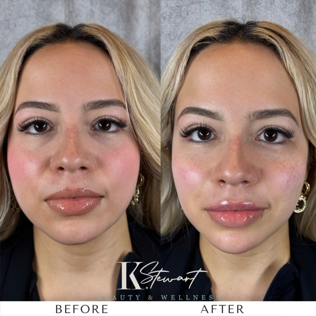Facial balancing before and after result